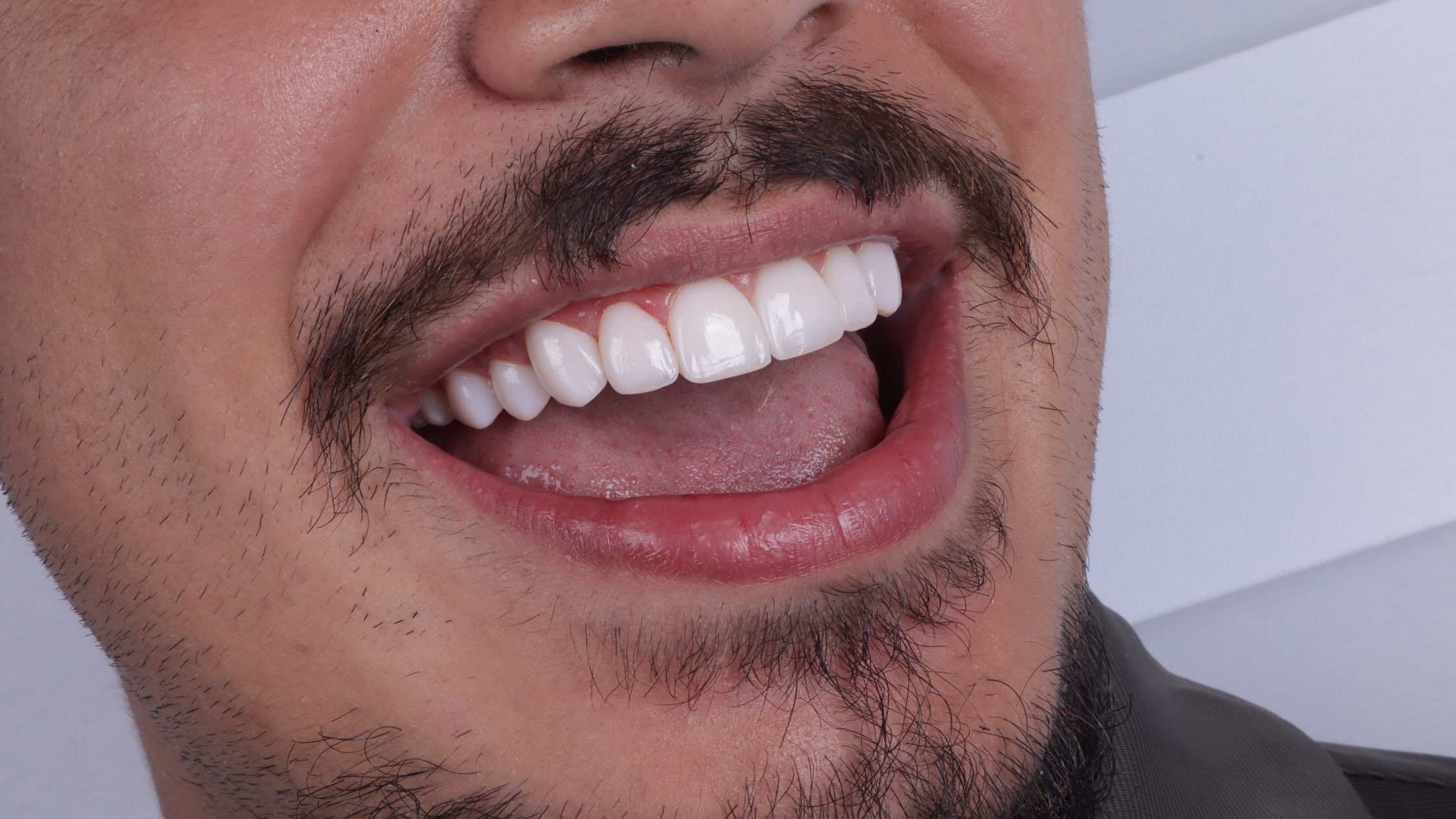 Camadas e estratificação da resina composta dental